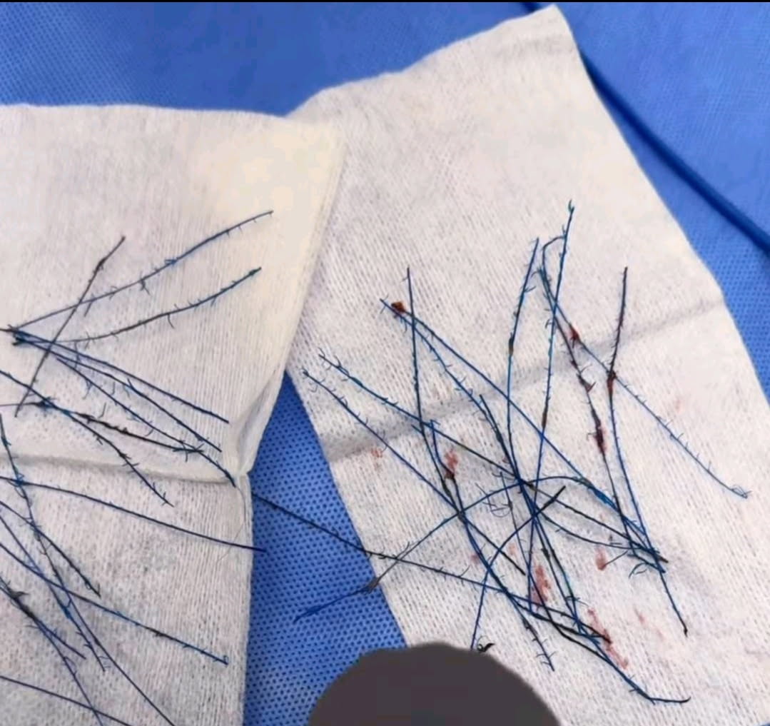 Thread Lifts